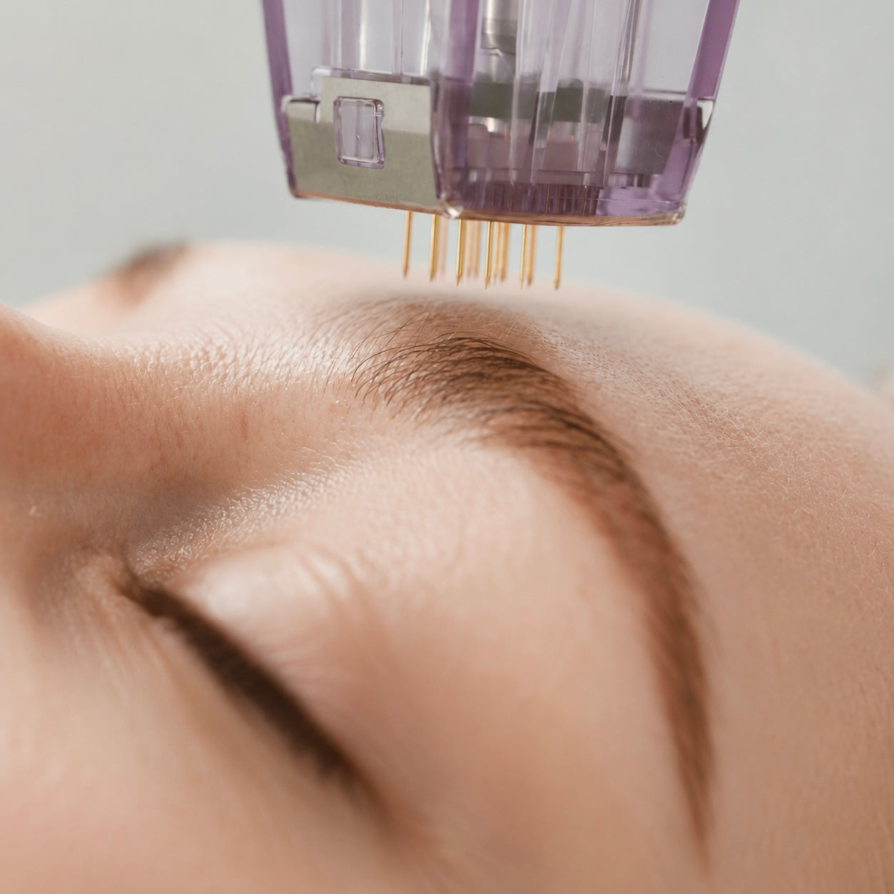 DoubleTite RF Microneedling